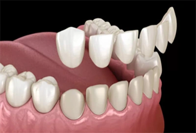 photo of dental veneers