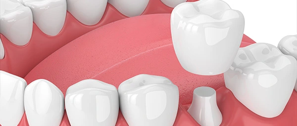 $899 same-day dental crowns