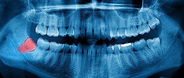 wisdom tooth removal special